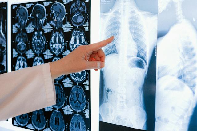 Rola Immunoterapii w Leczeniu Raka Płuc: Przełomowe Terapie i Perspektywy Przyszłości